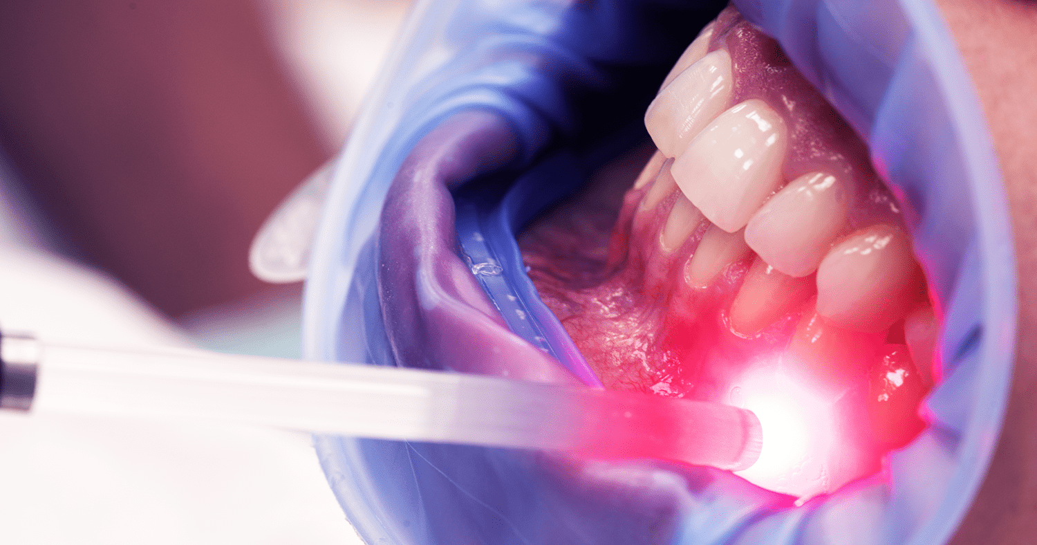 Sorriso Brilhante e Saudável: Descubra os Benefícios da Laserterapia Odontológica