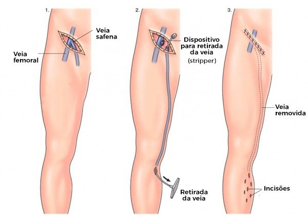 Cirurgia de varizes: tire todas as suas dúvidas sobre o pós-operatório -  Clínica Claf