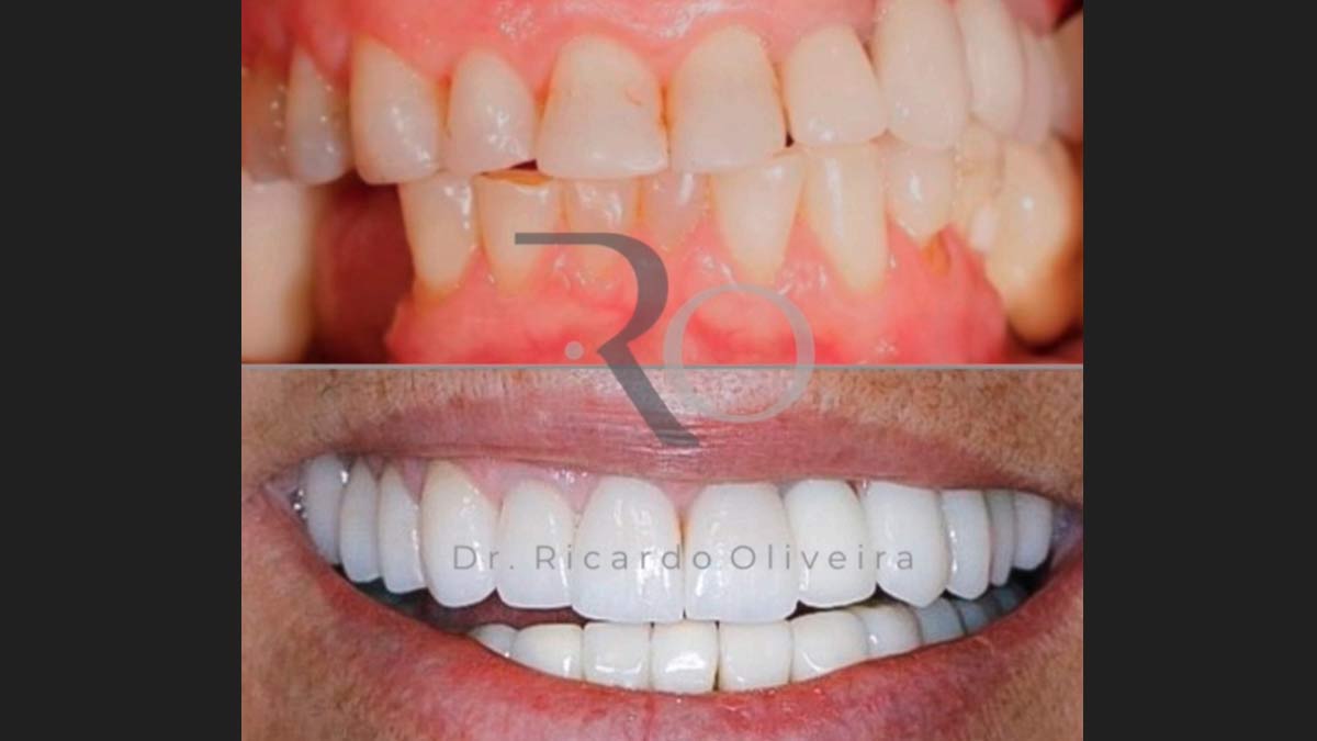 Sorrir com naturalidade - Com as lentes de contato dental é possível! -