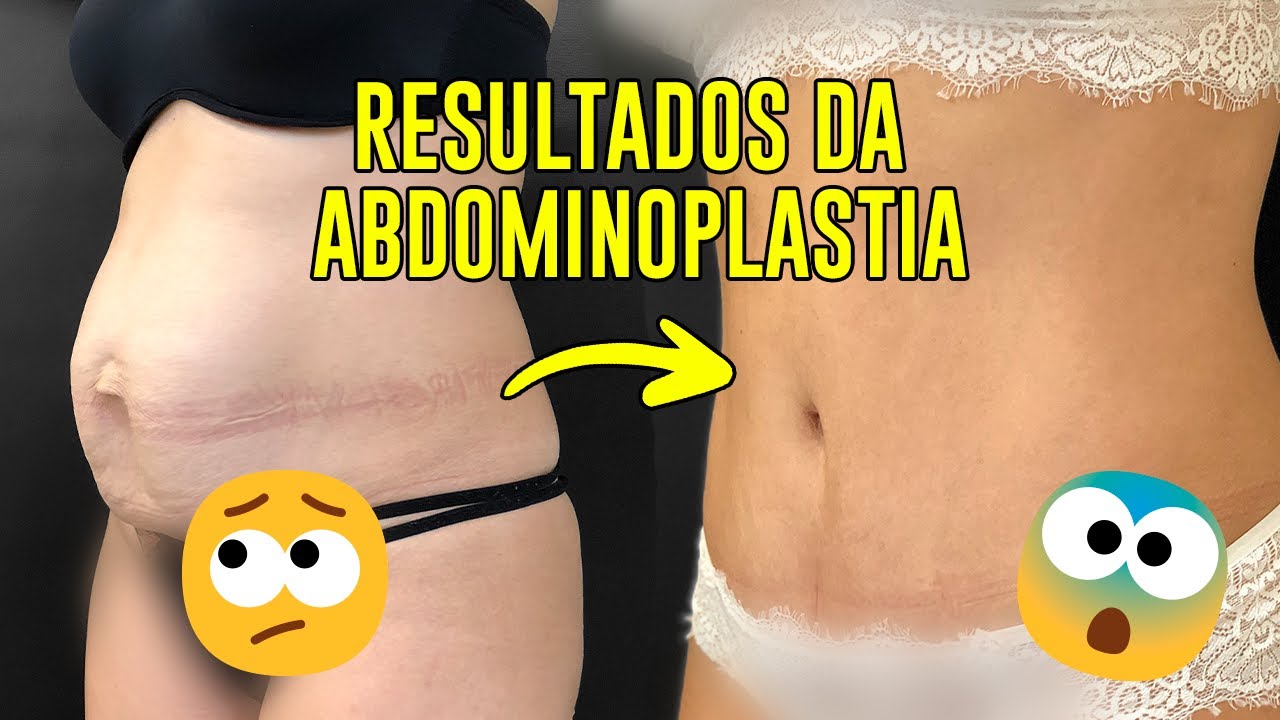 ABDOMINOPLASTIA - TUDO O QUE VOCÊ PRECISA SABER