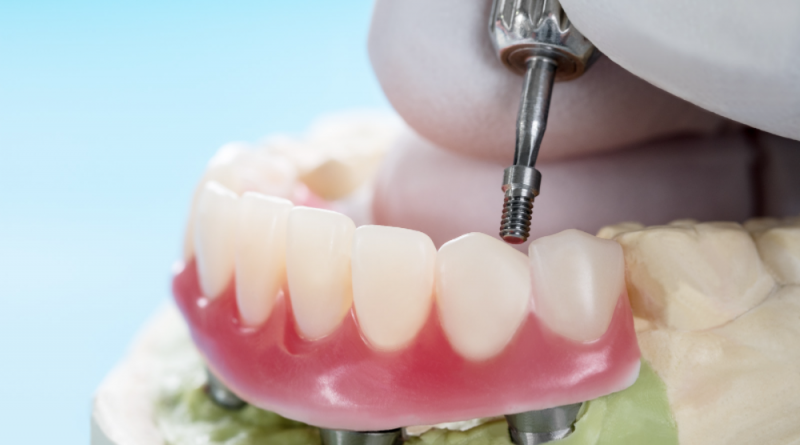  Med Odonto oferece implante dentário aos sócios a partir de R$ 490 -  Servidores de Americana