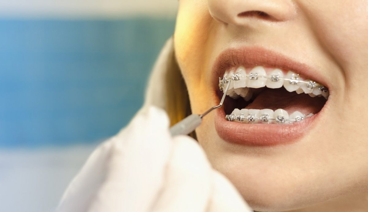 Aparelho Dentário: Mais do que um Sorriso Bonito, um Investimento em Sua Saúde e Bem-Estar!