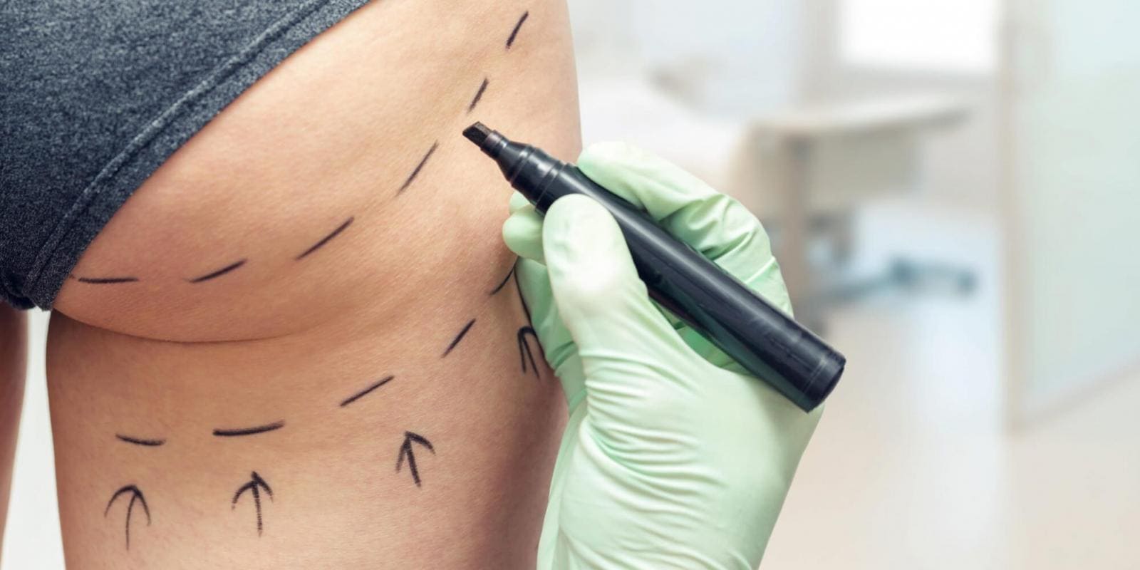 Gluteoplastia: Tudo o que Você Precisa Saber Sobre a Cirurgia para Aumento dos Glúteos